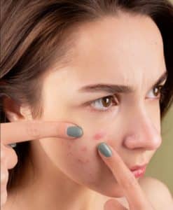 Read more about the article What is Acne and What are the Causes & Types of Acne? Why Do You Need Dermatology Compounding for Acne?