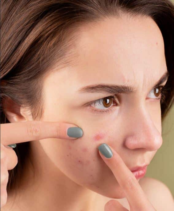 You are currently viewing What is Acne and What are the Causes & Types of Acne? Why Do You Need Dermatology Compounding for Acne?
